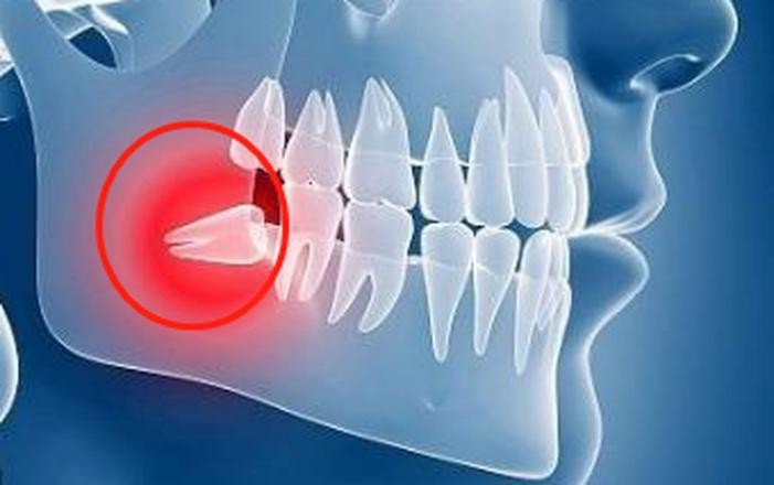"如果出现以上情况,多半是长了智齿,顶到前面的牙齿引发的疼痛.