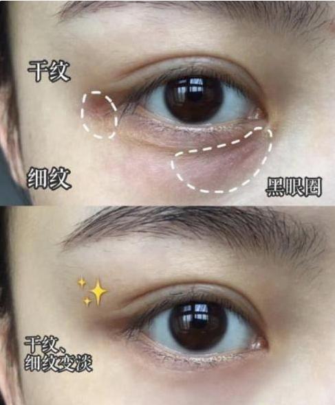 国外一女子花钱割了眼袋,如今"闭眼困难",其实变美不用这么麻烦