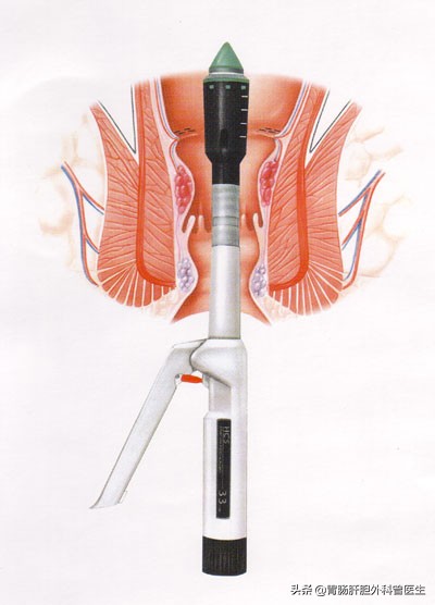 痔疮反复发作，是选择传统开刀手术，还是吻合器痔疮环切术好？