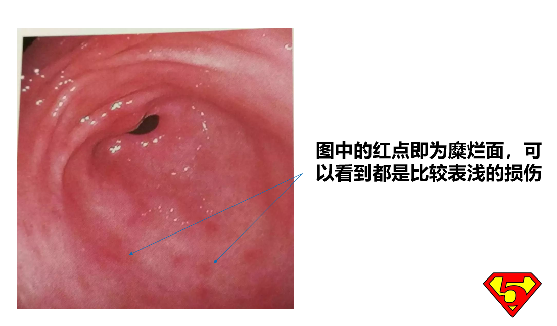 糜烂性胃炎反反复复，停药就犯？五个养胃建议请收好