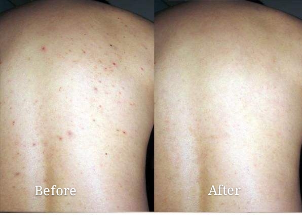 脸上有螨虫的症状图片(皮肤) - 赤虎壹号