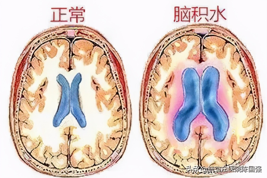 脑积水怎么治？如何正确认识脑积水的治疗？