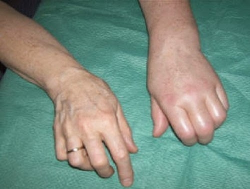 焦痛,肌营养不良,肩手综合征,反射性交感神经营养不良,苏德克萎缩