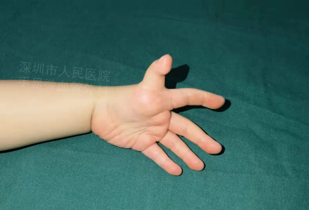 得了这病，12岁男孩手指比香蕉还粗！7种常见的手部畸形，家长们要注意
