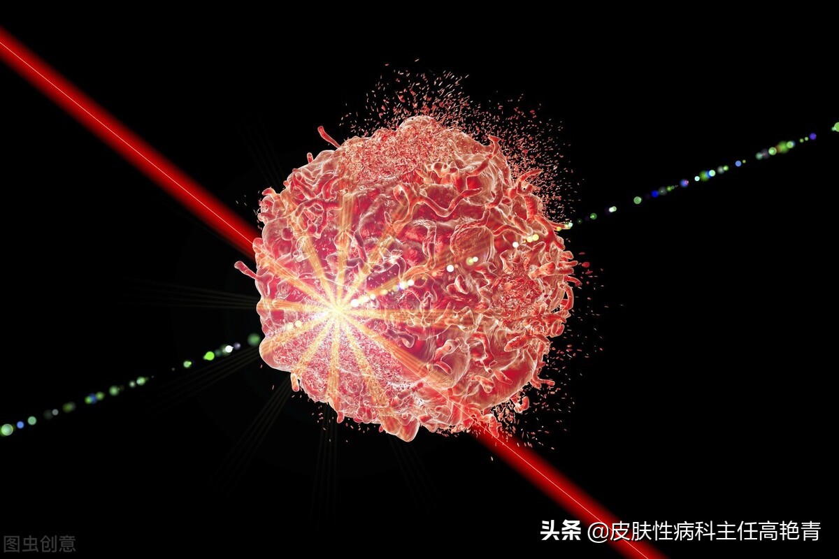 光动力疗法治疗尖锐湿疣的优势是什么？