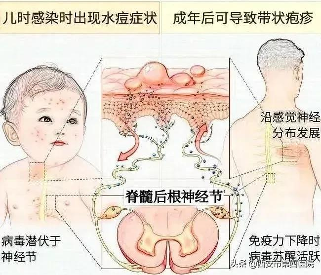 #健康中国行动2030#“缠腰龙”来了，别怕！！！请到这个科室报到！！！