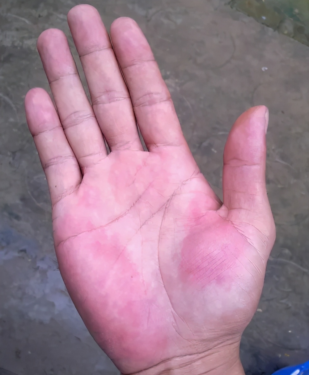 身上长出了红色"蜘蛛",我还有救吗?