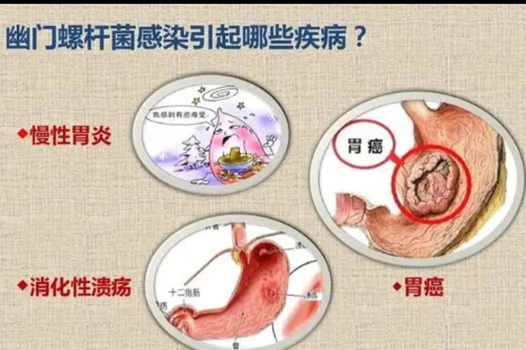 同学父亲腹痛消瘦做胃镜，结果一出来抱头痛哭，“我该早来的”