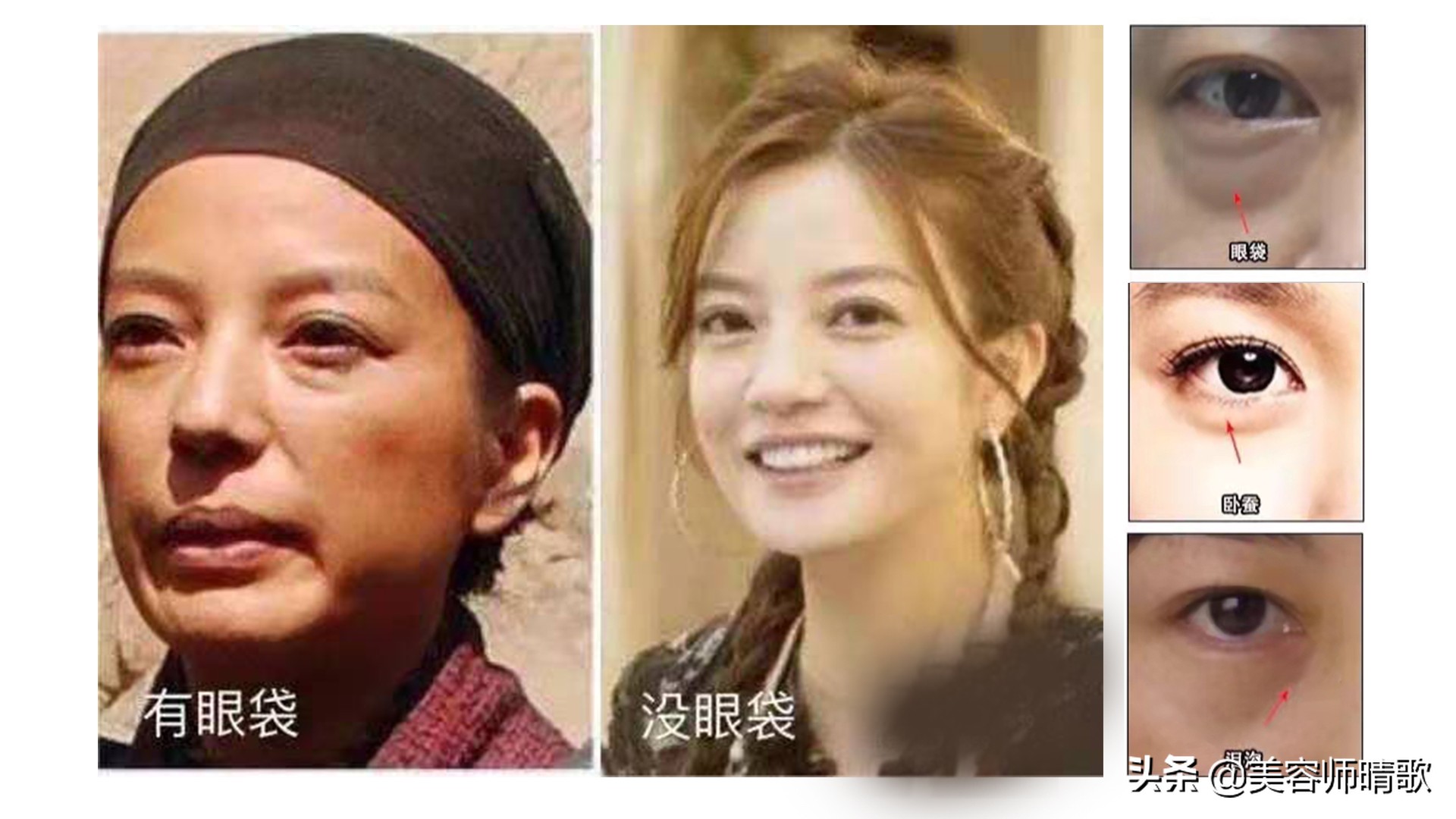 太好了！终于找到去眼袋的法子啦，5招去眼袋方法快收藏