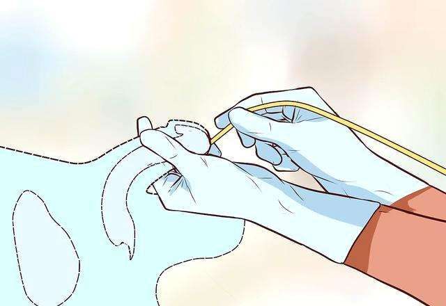 为什么在医院做手术都要"插尿管"?