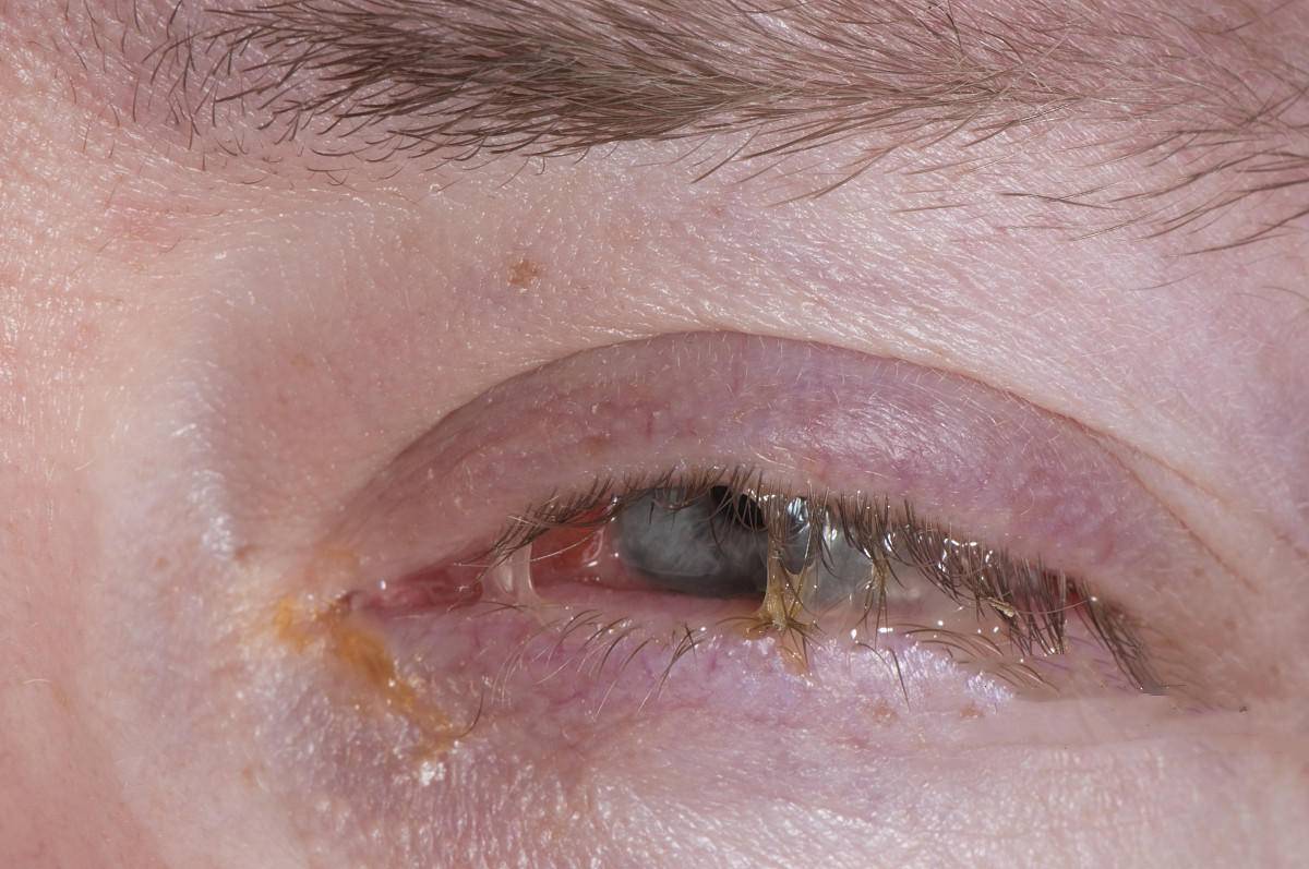 21岁小伙游泳后眼睛成了"兔眼睛",检查后发现是病毒性结膜炎