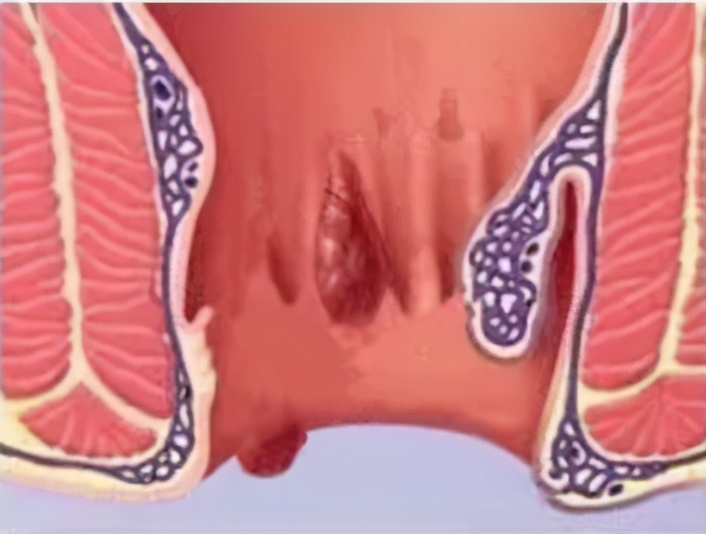 外痔疮长什么样子图片(杨大夫带你揭开血栓性外痔的前世今生) - 赤虎