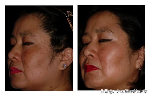 想用氢醌祛斑美白?请谨遵医嘱