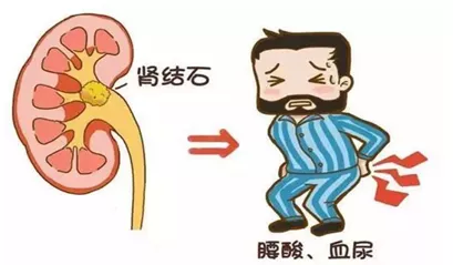 不开刀、不“打洞”!搞定肾结石,其实还可以这样做