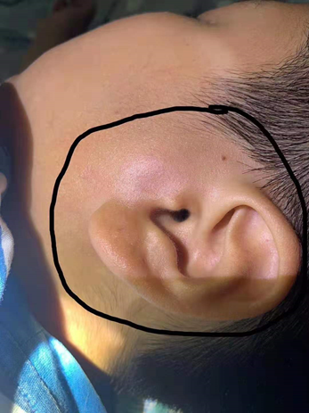 急性腮腺炎怎么治疗