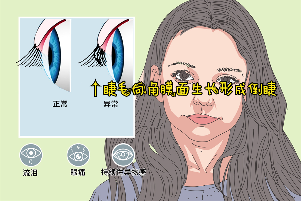 眼睛异物感持续困扰？常见原因及应对方法全解析
