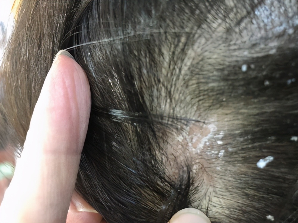 头上摸到的小疙瘩到底是什么？影响健康吗？医生一文解释清楚