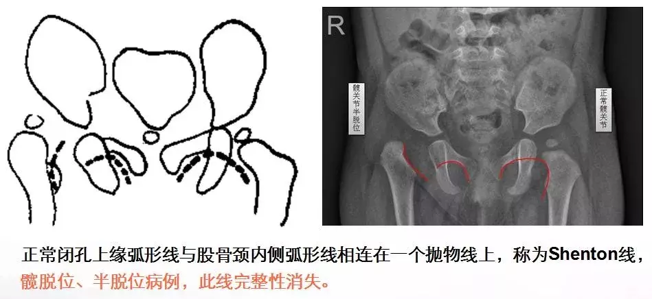 宝宝臀纹不对称妈妈不上心，长大后孩子走路一瘸一拐