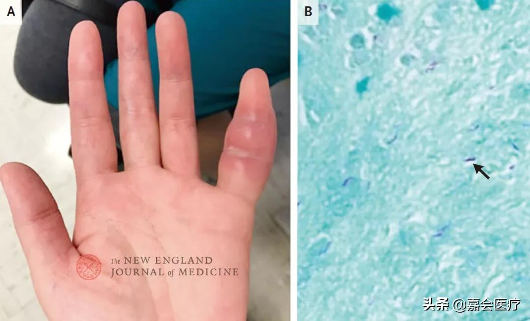 手指肿胀疼痛，真实病因原来在肺里，医生都觉得罕见