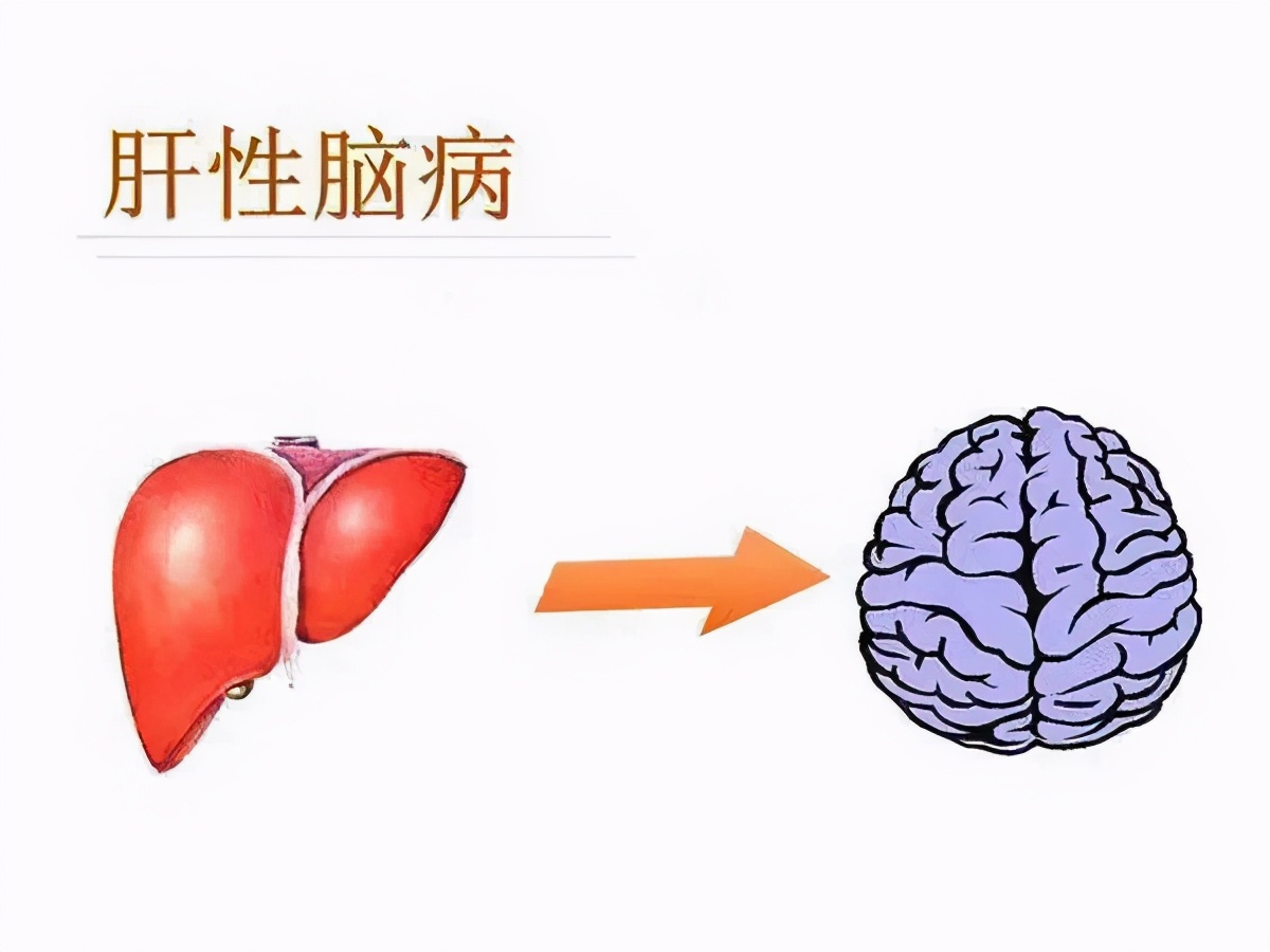 治疗肝硬化有哪些方式？医生：4个治疗方案，把你拉出鬼门关