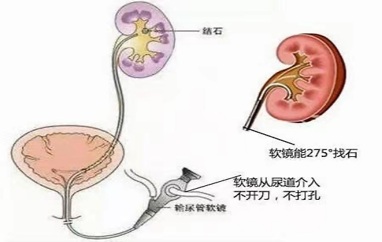 5药多角度松弛膀胱平滑肌，抑制前列腺增生，缓解尿频尿急尿失禁