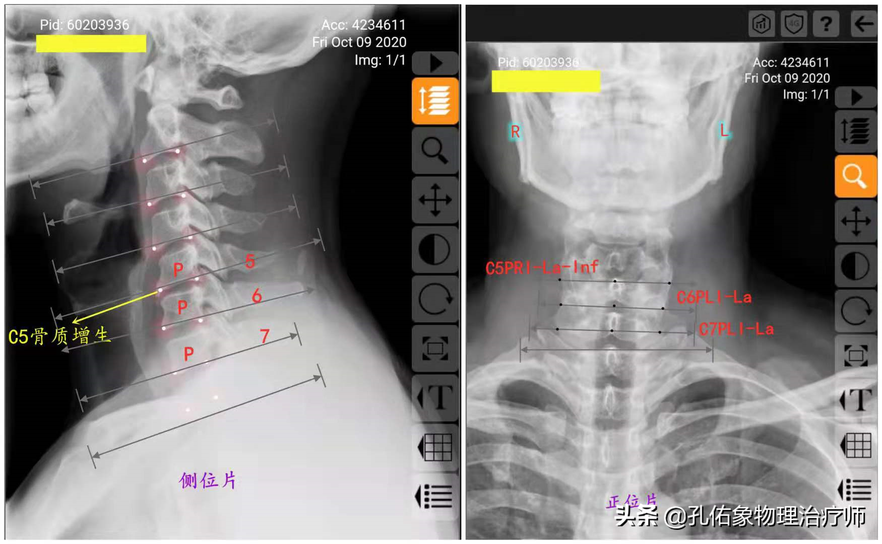 颈椎病很困惑，要如何治疗呢？一文详细告知您不一样的策略方法