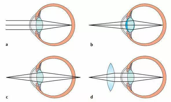 而"近视"无需调节也可以使近处的景物成像在视网膜上,即看近仍清晰(图