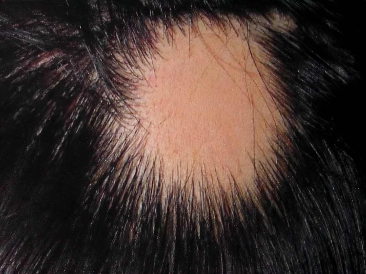 一般来说每天掉头发在50根以内是没有必要担忧会发生秃头的风险的