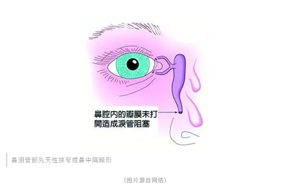 宝宝经常流眼泪、眼屎多，千万不容忽视