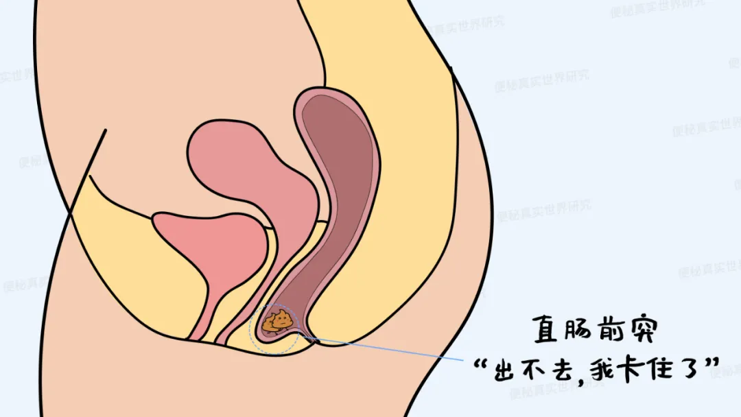 大便堵在肛门处，医生却让我多做这个动作