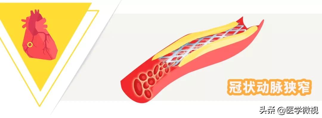 心脏支架降至700元！什么情况下，患者就需要做支架手术了？