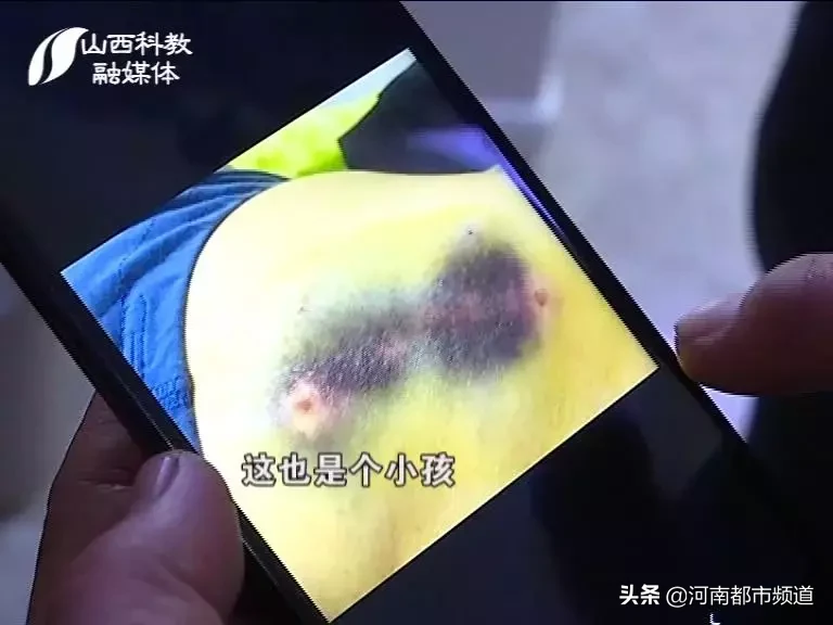 山西一小区流浪狗突然发狂!接连咬伤19人后逃了!其中还有孩子