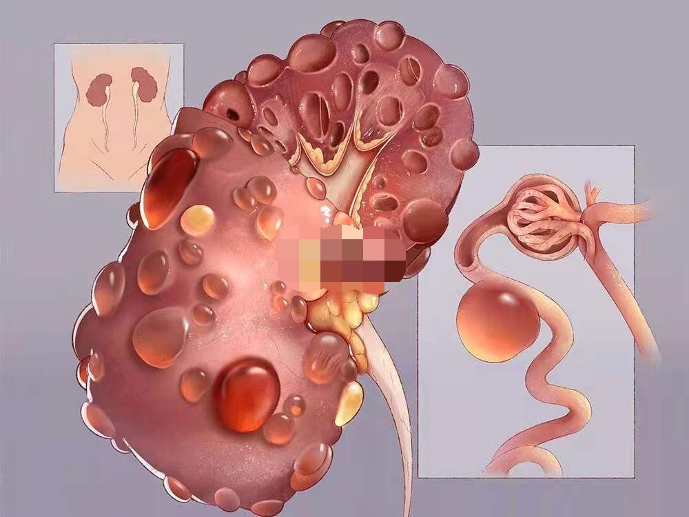 多囊肾和正常肾的图片图片