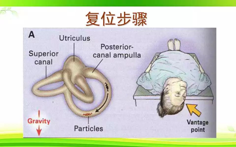 保持该头位使患者躺下,同时,头后悬30°,这时耳石在半规管内产生移动