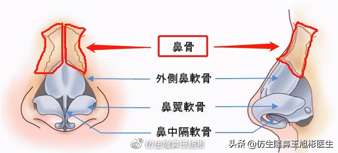 侧脸高鼻梁正脸矮塌鼻，鼻骨过宽惹的祸，鼻骨内推了解下