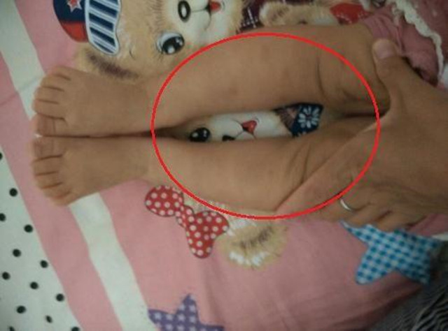 新生儿腿弯弯的,会是"罗圈腿"吗?家长需分清不同原因