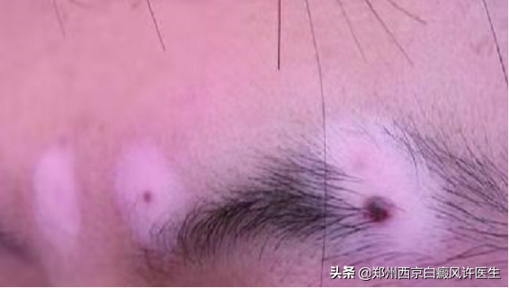 新乡晕痣型白癜风白斑治疗方案