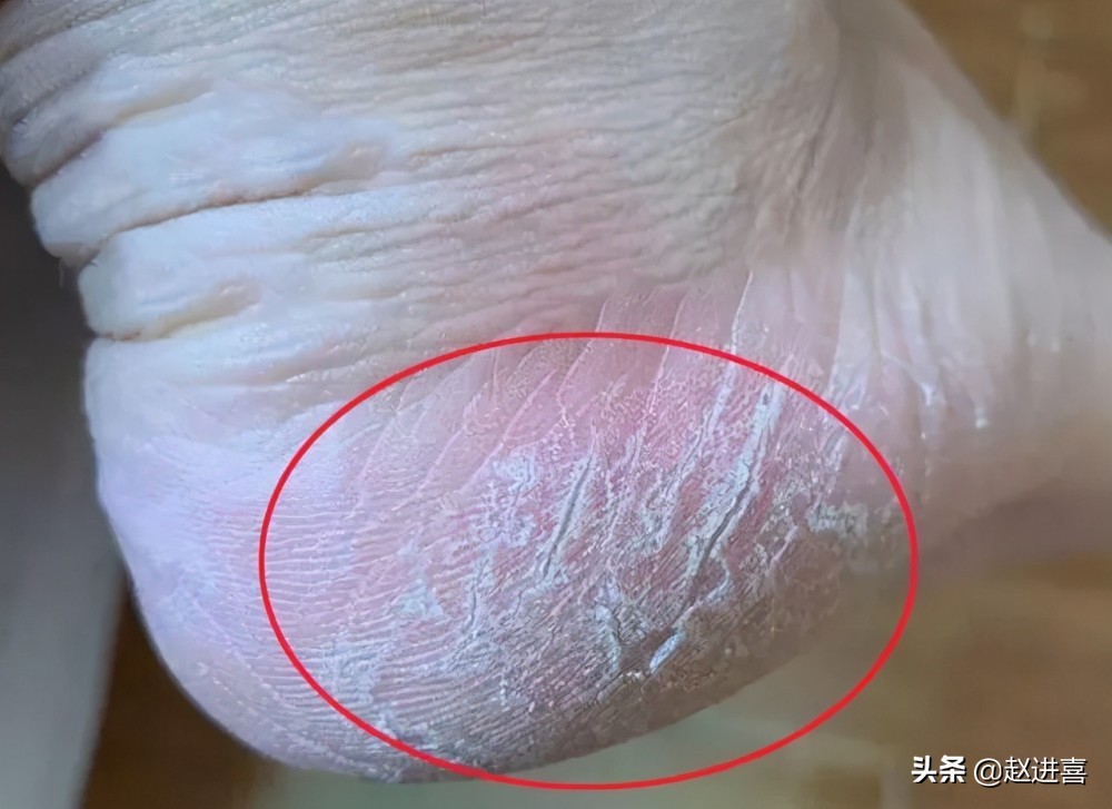 糖尿病患者脚麻要注意了，这四个表现都是糖尿病足典型症状