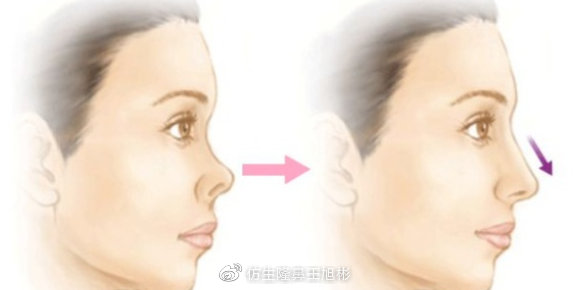 短鼻延长？揭秘中庭短、朝天鼻（猪鼻子）、挛缩鼻部整形原理方法