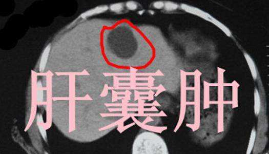 肝囊肿有多严重？为什么有人要做肝移植，医生告诉你答案