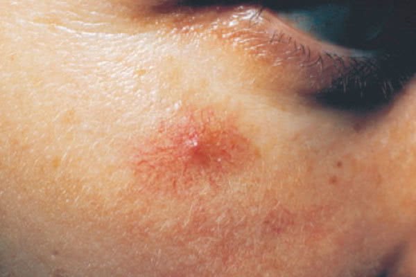 黑痣癌变的征兆图片(皮肤癌) - 赤虎壹号