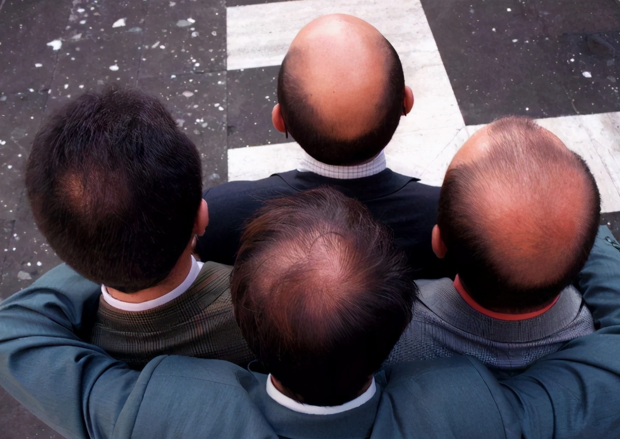 大学“越学越秃”4大专业，生发灵都拯救不了，有你的专业吗？