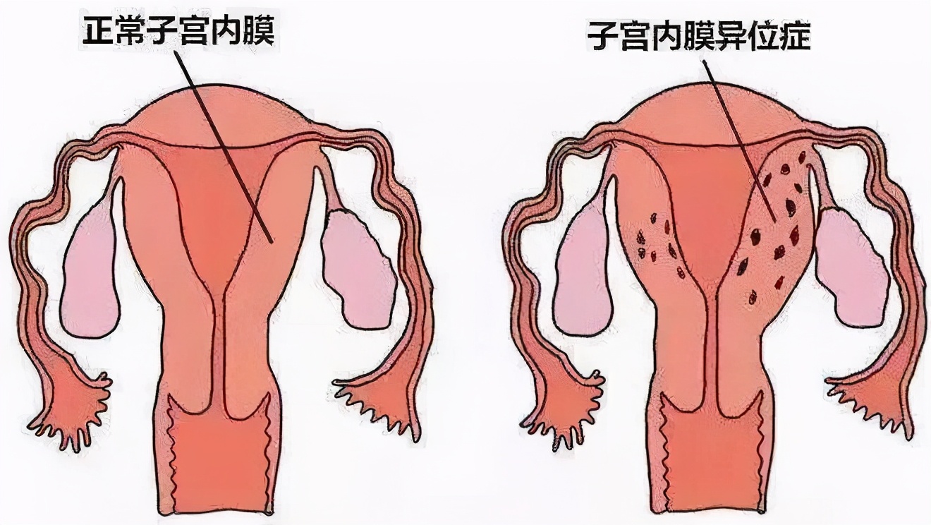 什么是子宫内膜异位症？得了子宫内膜异位症怎么治疗