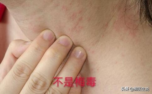 正确认识梅毒,不是什么皮下疳都叫梅毒,记住这几点准没错!