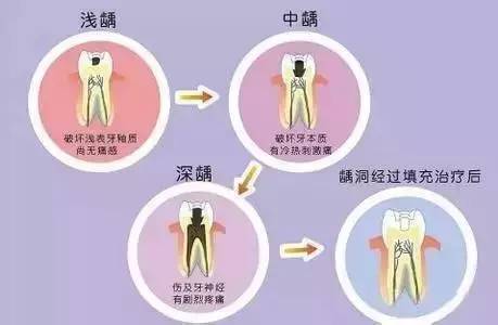 蛀牙烂到神经的症状表现及自查方法
