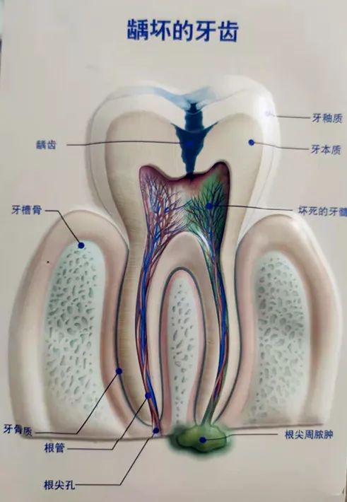 该死的蛀牙鬼打墙！每天盯着娃刷牙，为啥还是会蛀牙？