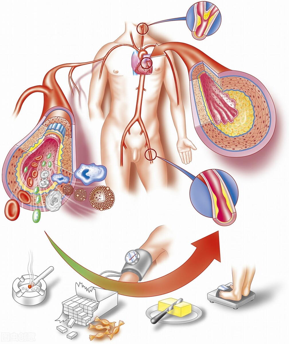 动脉粥样硬化闭塞怎么办？专科医生告诉您这样治疗效果好