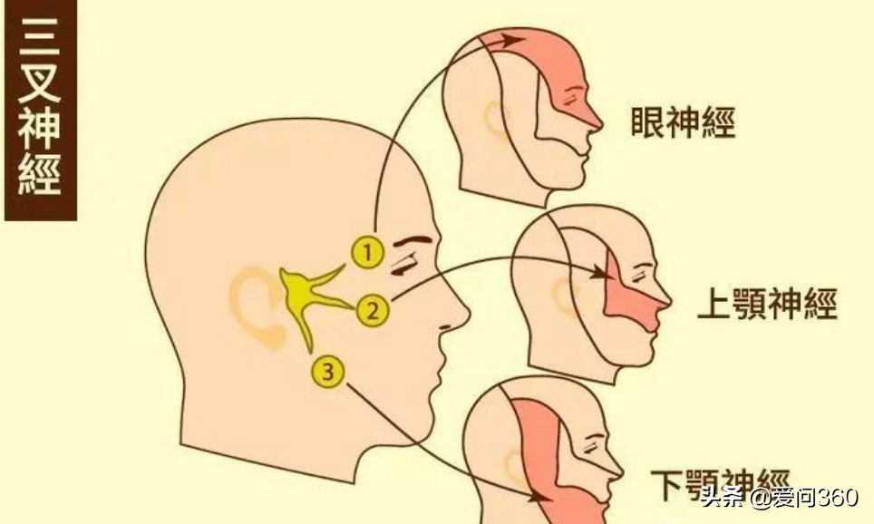 三叉神经痛实在太疼，这些原因要知道，如何缓解？