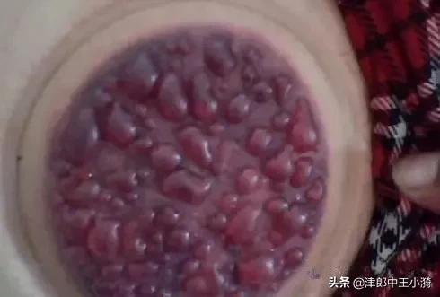 体内有湿气？4个表现帮您判断