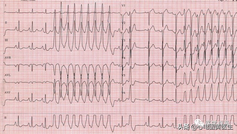 心电图一个小格多少秒(零) - 青木春